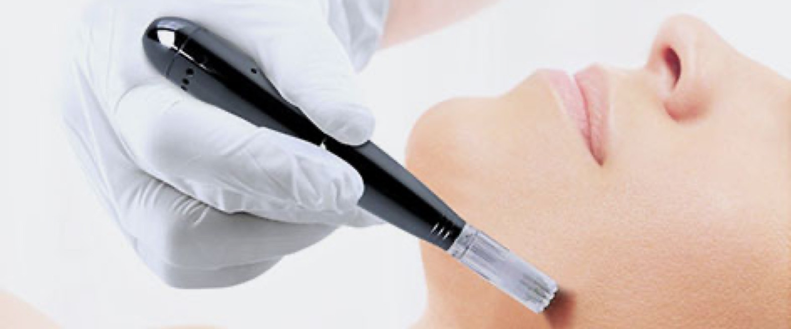 Microneedling 